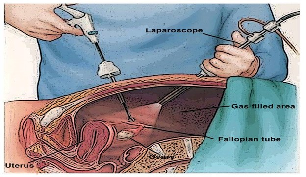 Laparoscopic Surgery - Healix Hospitals